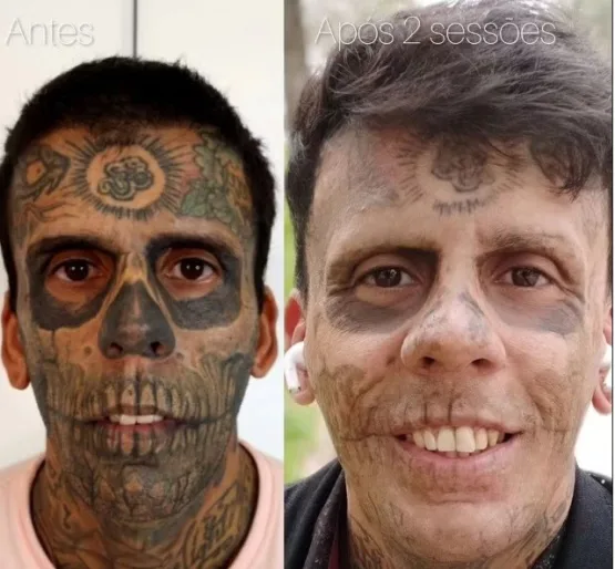 Homem 'mais tatuado do Brasil' começa a remover tatuagens; saiba o motivo