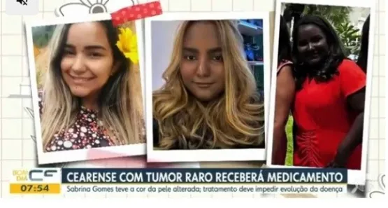 Jovem com tumor raro que alterou cor da pele deixa UTI e aguarda melhora para receber medicação