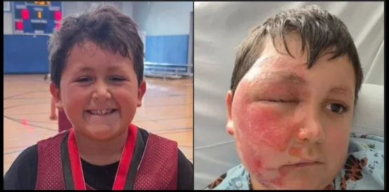 Menino faz desafio do TikTok e acaba com rosto desfigurado