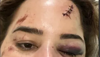 'Estar viva é um milagre', diz psicóloga que ficou na UTI após ser arremessada de montanha-russa