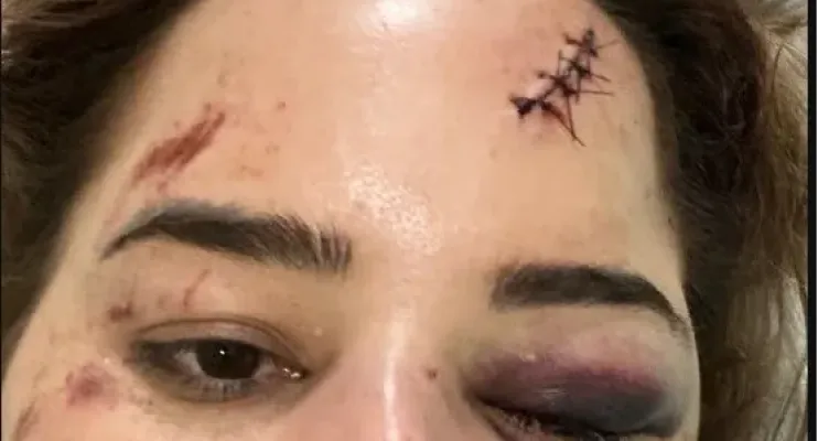 'Estar viva é um milagre', diz psicóloga que ficou na UTI após ser arremessada de montanha-russa