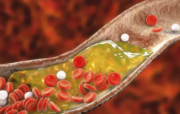 'Assassino silencioso': Colesterol perigosamente elevado vê-se no rosto