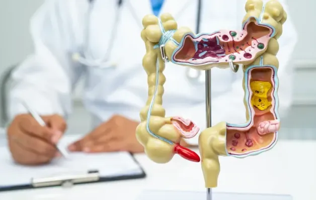 5 curiosidades que precisa saber sobre doenças inflamatórias intestinais