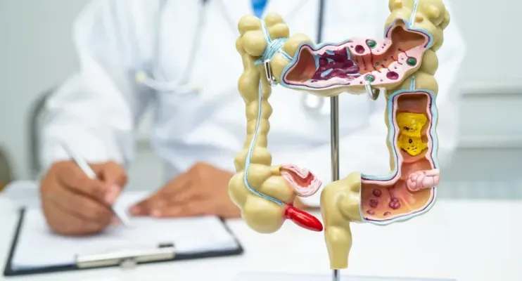 5 curiosidades que precisa saber sobre doenças inflamatórias intestinais