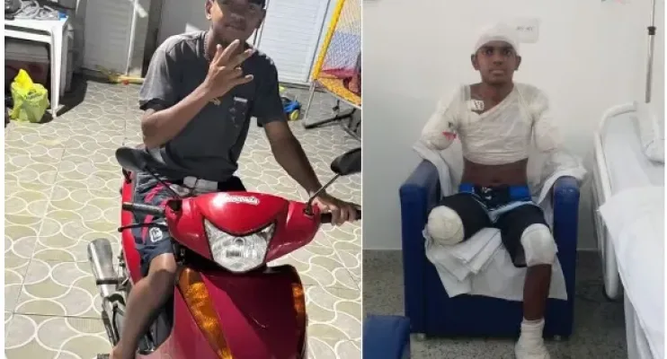 Adolescente tem braços, perna e parte de pé amputados após levar choque