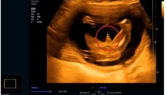 Bebê diverte ao mostrar genitais em ultrassom e acabar com chá revelação: "Impossível não ver"