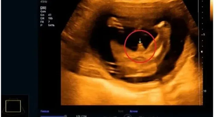 Bebê diverte ao mostrar genitais em ultrassom e acabar com chá revelação: "Impossível não ver"