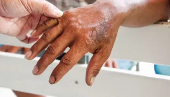 Brasil é o segundo país com maior número de casos de hanseníase no mundo