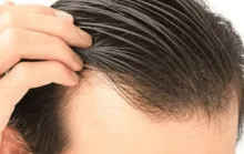 Cabelo transplantado pode cair? Veja alguns detalhes sobre o procedimento