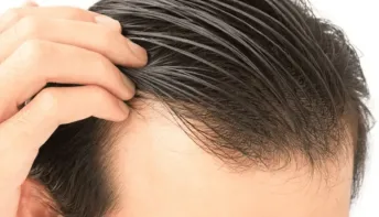 Cabelo transplantado pode cair? Veja alguns detalhes sobre o procedimento