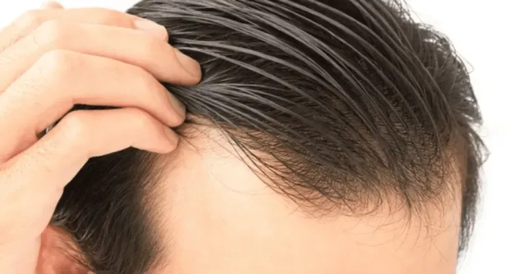 Cabelo transplantado pode cair? Veja alguns detalhes sobre o procedimento