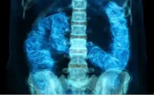 Câncer de intestino: diagnóstico precoce pode salvar maioria
