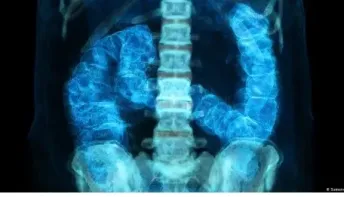 Câncer de intestino: diagnóstico precoce pode salvar maioria
