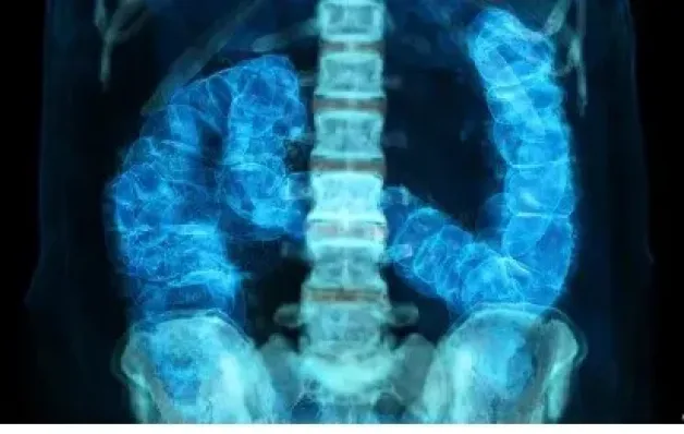 Câncer de intestino: diagnóstico precoce pode salvar maioria