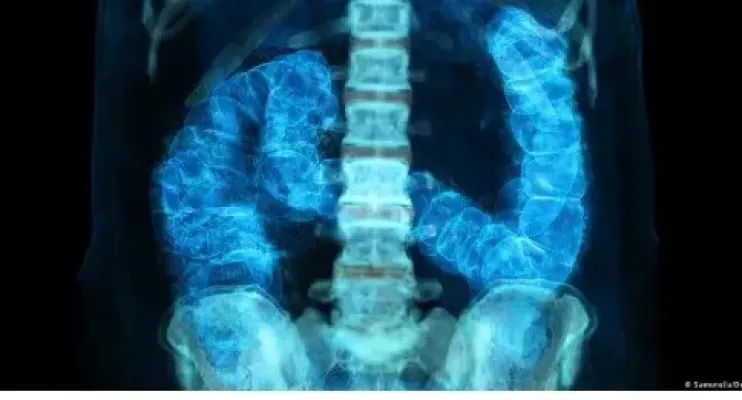 Câncer de intestino: diagnóstico precoce pode salvar maioria