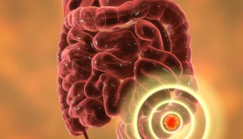 Câncer de intestino: doença cada vez mais comum acende alerta em especialistas