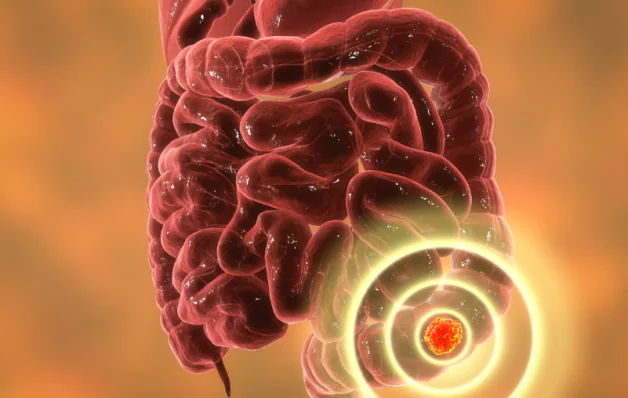 Câncer de intestino: doença cada vez mais comum acende alerta em especialistas