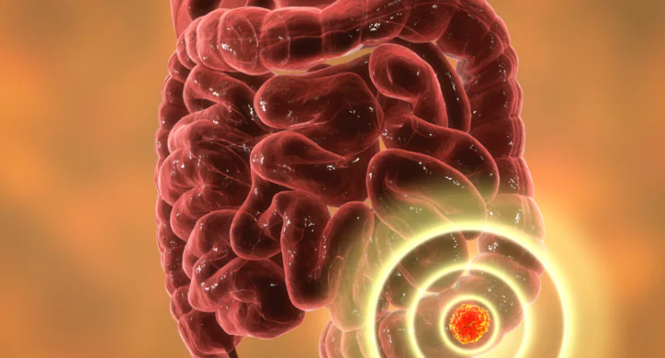 Câncer de intestino: doença cada vez mais comum acende alerta em especialistas
