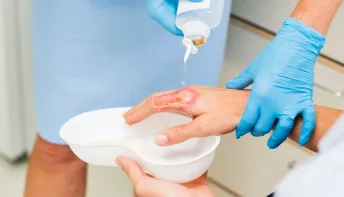 Centro de Tratamento de Queimados do Hospital Dr. Jayme alerta para risco de queimaduras
