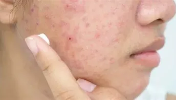Cicatrizes de acne: entenda as causas e como tratar