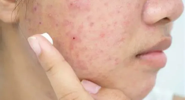 Cicatrizes de acne: entenda as causas e como tratar
