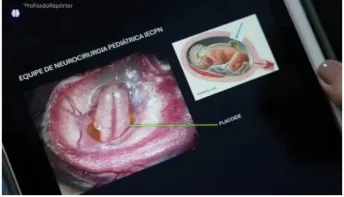 Cirurgia do SUS corrige coluna de bebê antes de nascer, com útero retirado e devolvido