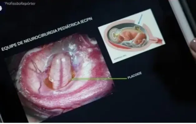 Cirurgia do SUS corrige coluna de bebê antes de nascer, com útero retirado e devolvido