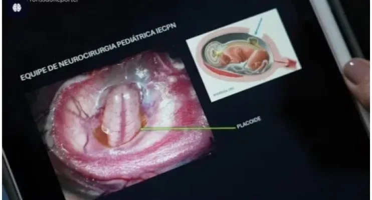Cirurgia do SUS corrige coluna de bebê antes de nascer, com útero retirado e devolvido