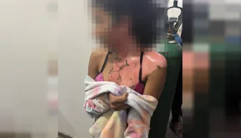 Com ciúme do marido, mulher despeja água fervendo na cabeça da sobrinha