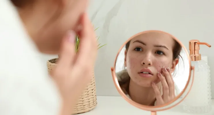 Como distinguir acne hormonal de acne causada pelo stress