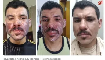 Coxinha queima homem no rosto ao explodir após ser retirada de panela com óleo