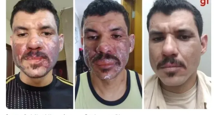 Coxinha queima homem no rosto ao explodir após ser retirada de panela com óleo
