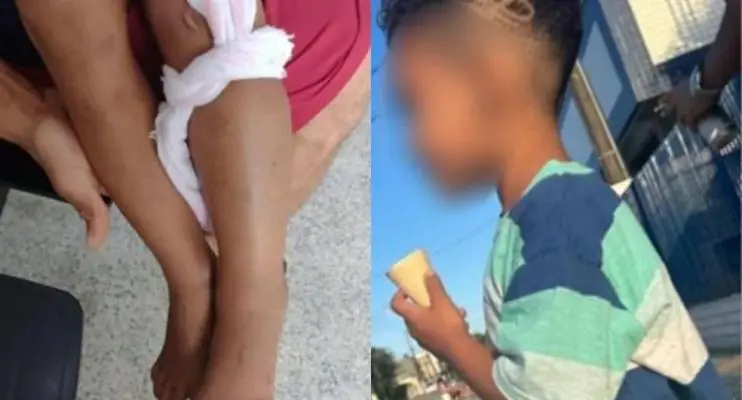 Criança é mordida por cobra e vai para UTI após confundir animal com galho