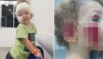 Criança tem parte do rosto rasgado após ser atacada pelo cachorro da babá 
