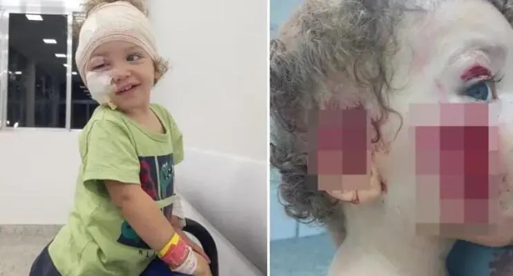 Criança tem parte do rosto rasgado após ser atacada pelo cachorro da babá 