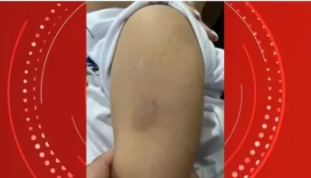  Cuidadora é demitida após morder criança de 3 anos em escola