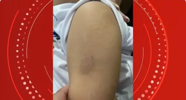  Cuidadora é demitida após morder criança de 3 anos em escola