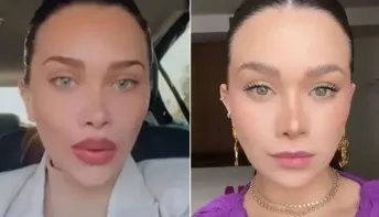 Desarmonização facial: nova tendência é reverter exageros estéticos