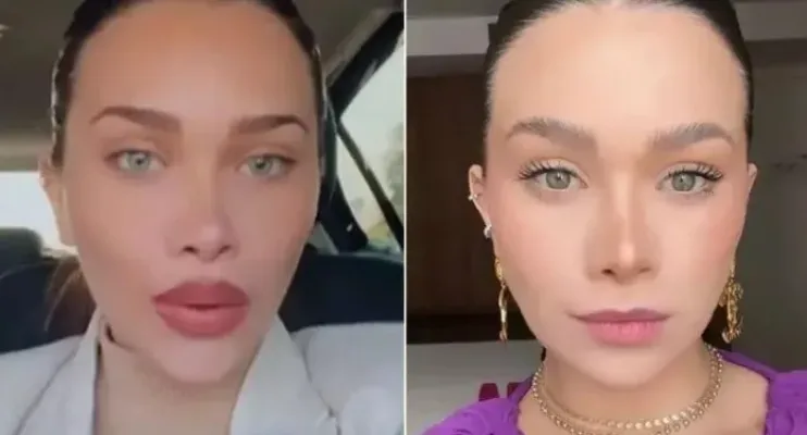 Desarmonização facial: nova tendência é reverter exageros estéticos