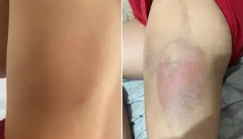 Pai agride e ameaça ‘sumir’ com a filha de 7 anos se ela contasse sobre hematomas
