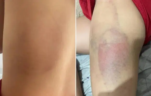 Pai agride e ameaça ‘sumir’ com a filha de 7 anos se ela contasse sobre hematomas