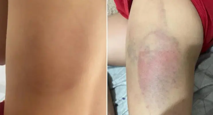 Pai agride e ameaça ‘sumir’ com a filha de 7 anos se ela contasse sobre hematomas