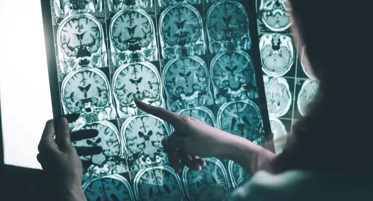 Exame de sangue para diagnóstico de Alzheimer chega ao Brasil