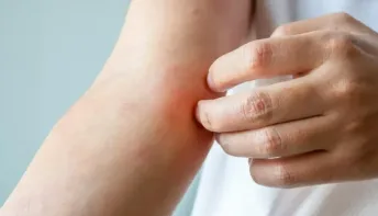 Fungo sexual acende alerta sanitário internacional
