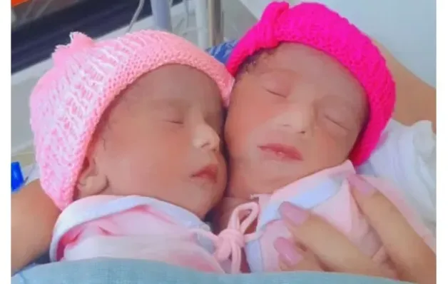 Gêmeas siamesas ligadas por um só coração morrem seis dias após nascimento