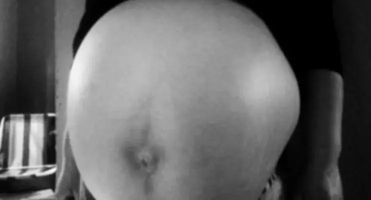 Grávida de gêmeas siamesas com malformação tem pedido negado em todas as instâncias para abortar gravidez de risco