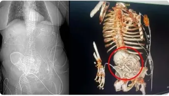 idosa de 81 anos descobre feto calcificado que carregou por mais de 5 décadas
