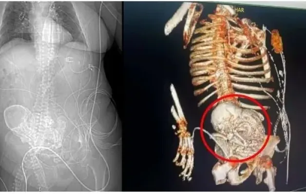idosa de 81 anos descobre feto calcificado que carregou por mais de 5 décadas
