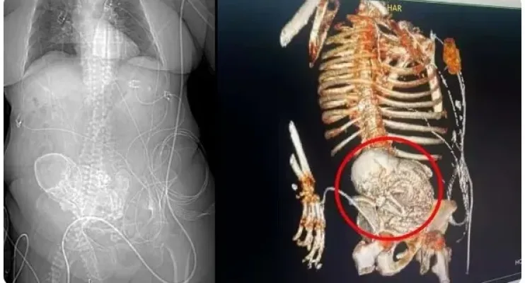idosa de 81 anos descobre feto calcificado que carregou por mais de 5 décadas