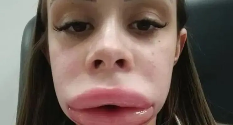 Jovem faz preenchimento labial e descobre doença rara após inchaço incomum